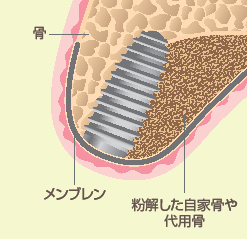 GBR法(骨誘導再生治療法)