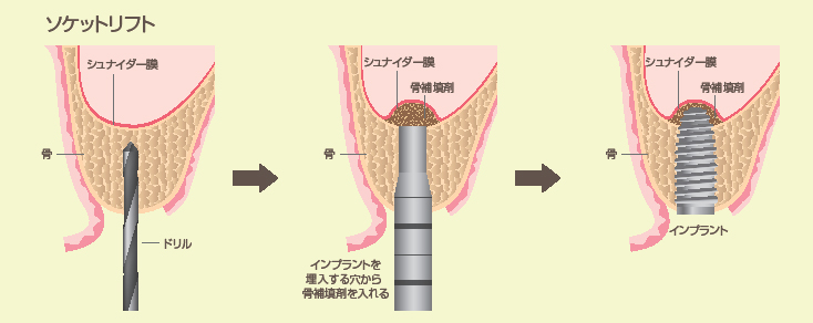 ソケットリフト(上顎洞底拳上術)