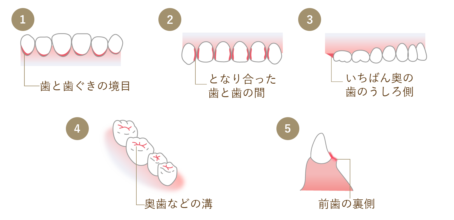 プラークのたまりやすい場所